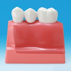 Maxi Implantat/Bro Studiemodel 